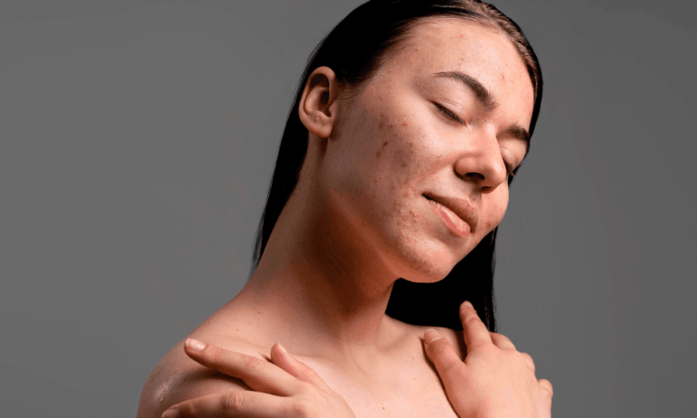 Acne e saúde mental