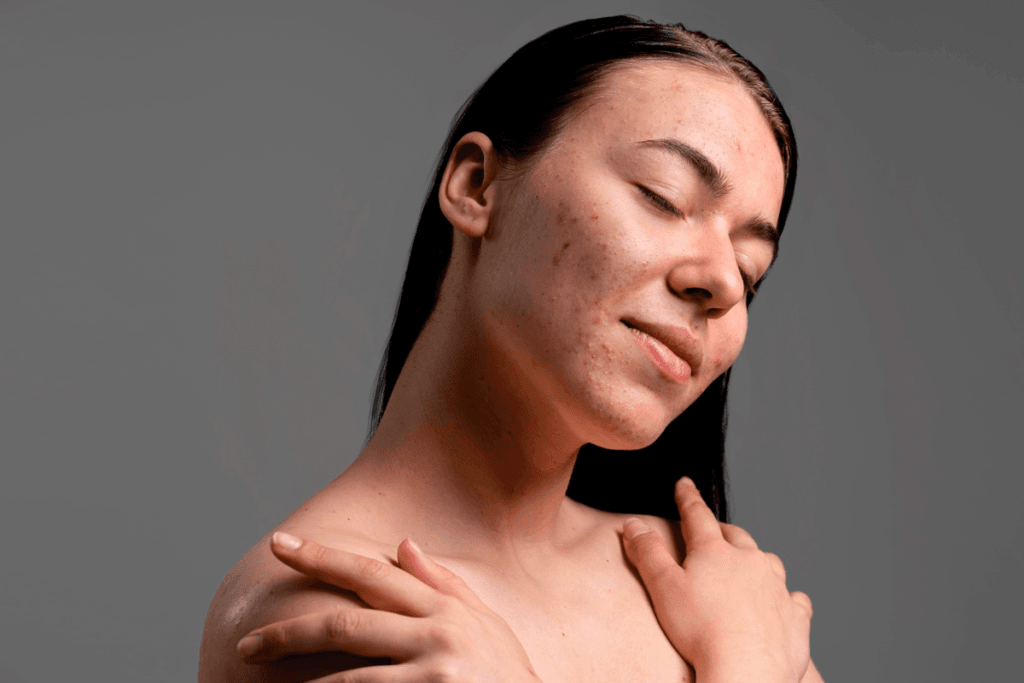 Acne e saúde mental