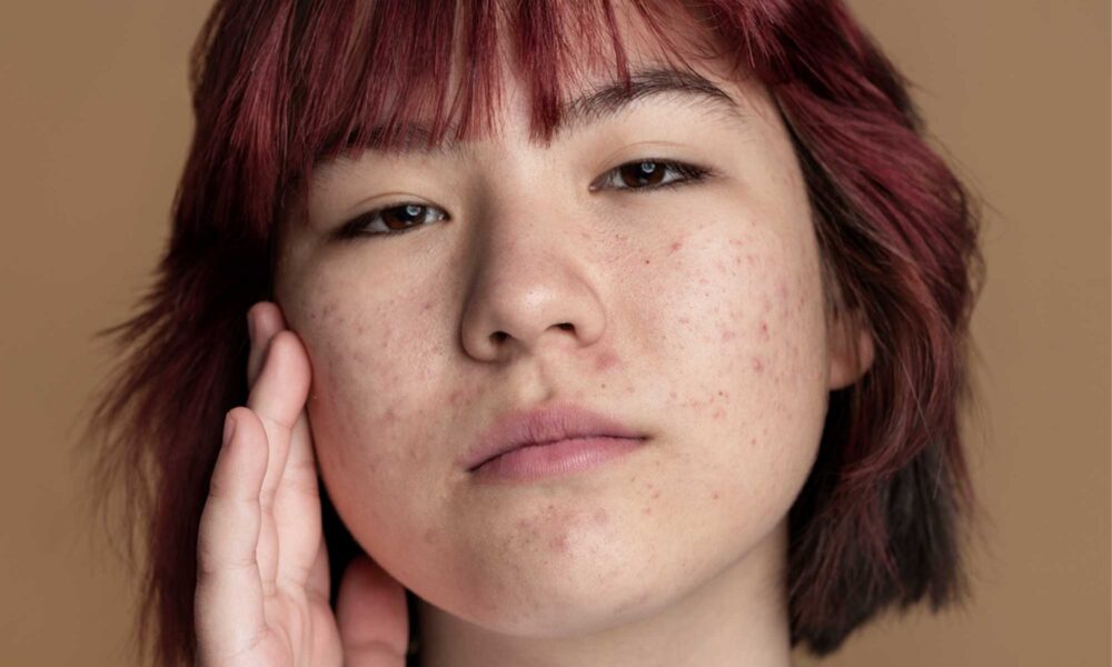 Acne solar
