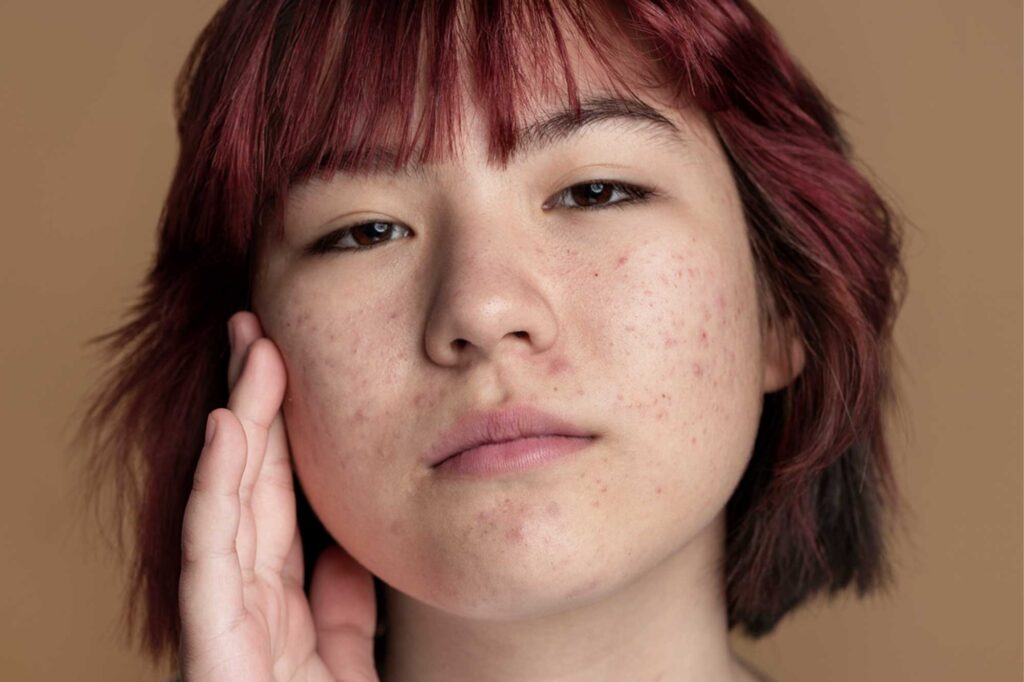 Acne solar