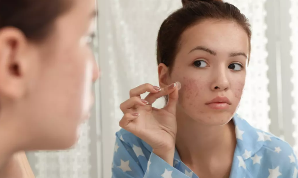 Adesivos para espinhas: uma solução para combater a acne