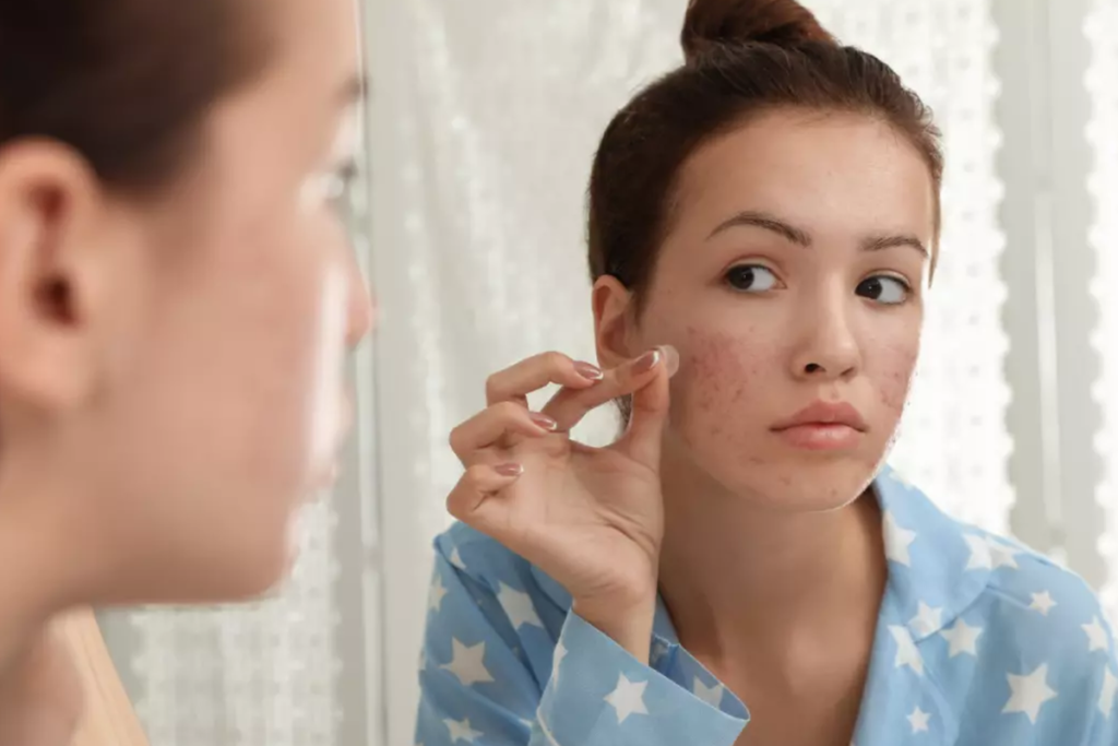 Adesivos para espinhas: uma solução para combater a acne