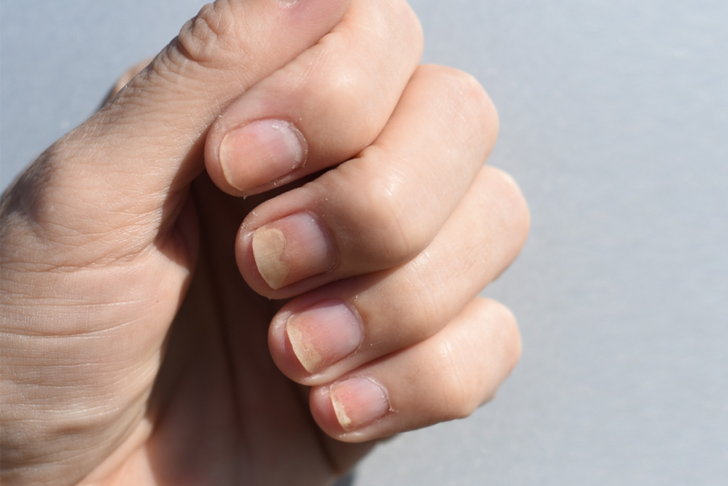 Unha amarelada: Causas, Prevenção e Importância de Manter as Unhas Saudáveis