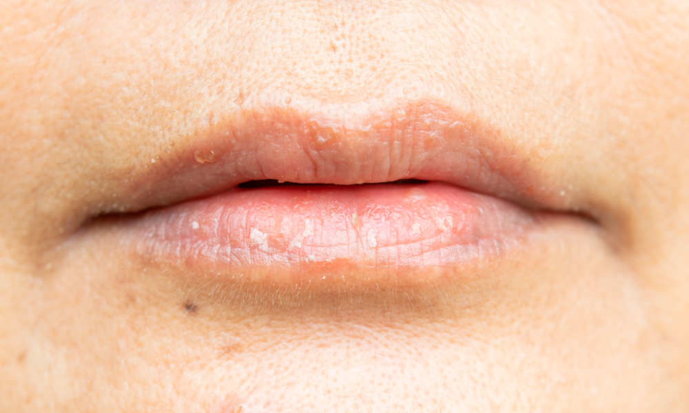 Lábios ressecados: o que causa, como tratar e prevenir esse incômodo