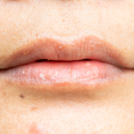 Lábios ressecados: o que causa, como tratar e prevenir esse incômodo