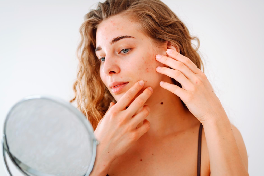 Gel Secativo para Espinhas
