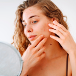 Gel Secativo para Espinhas